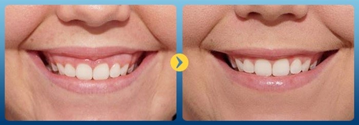Nướu răng phát triển mạnh làm một phần thân răng nằm sâu trong lợi gây nên tình trạng cười hở lợi